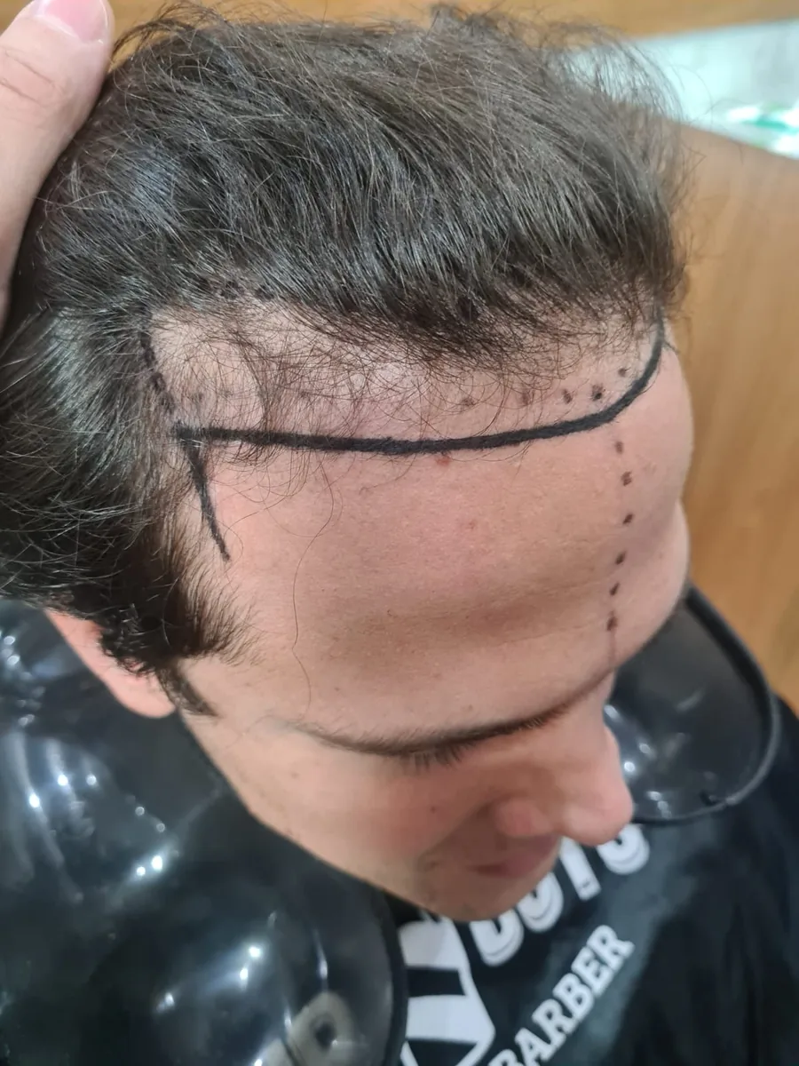Caso 01 antes do transplante, com marcação da nova linha frontal