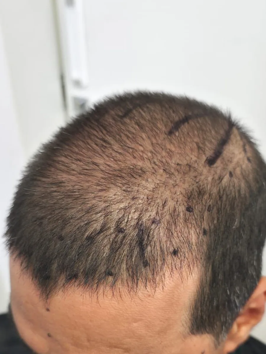 Caso 04 antes do transplante, com baixa densidade no topo e marcação