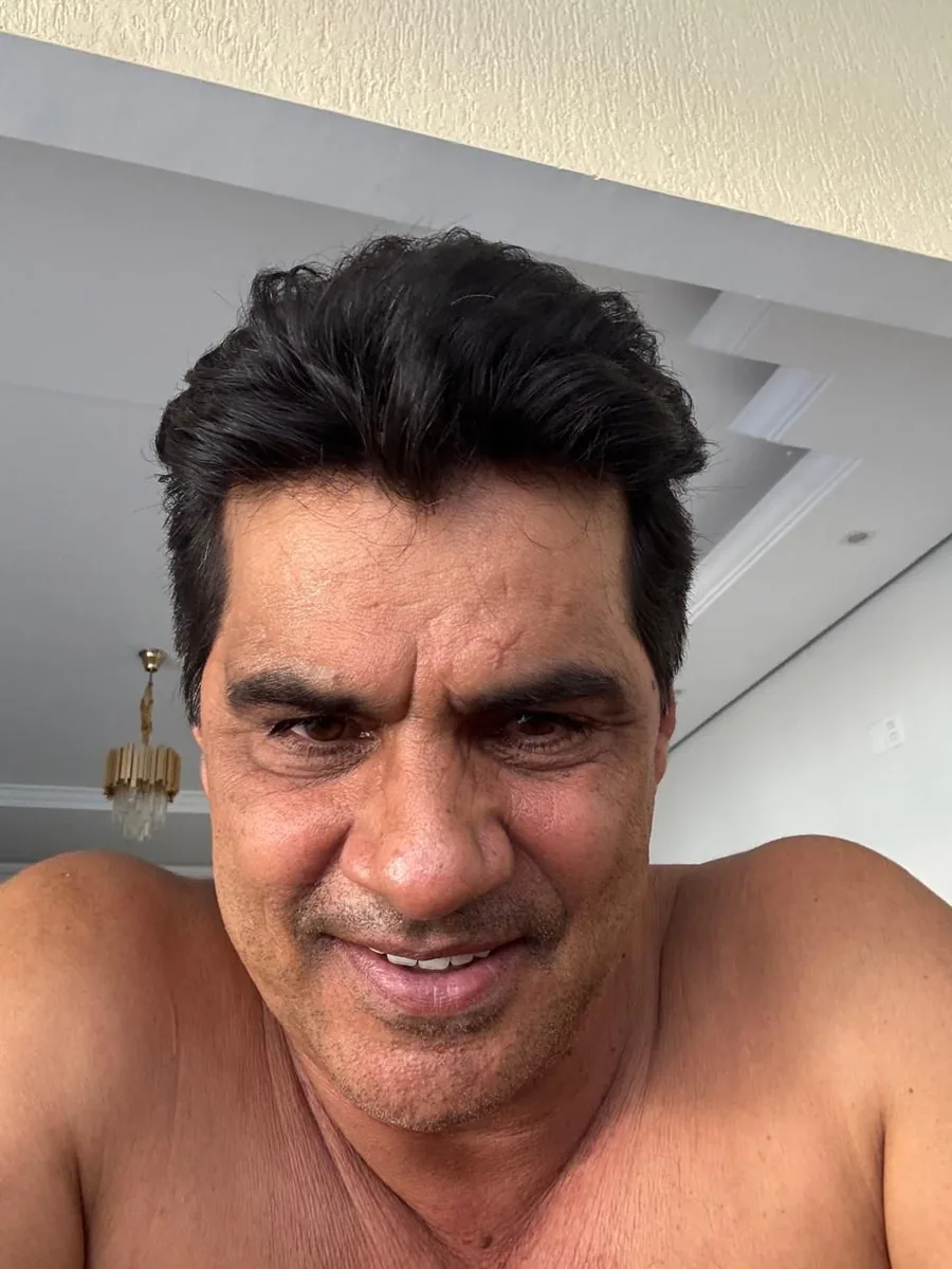 Caso 04 depois do transplante capilar