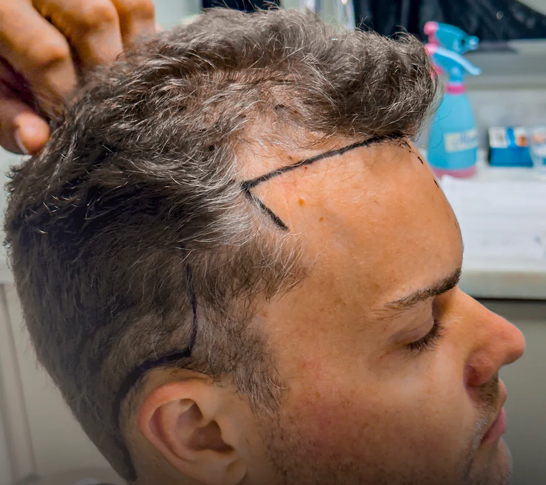 Marcação do desenho da linha frontal antes do transplante